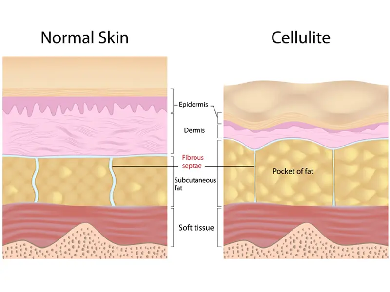How to Get Rid of Cellulite: Expert Treatment & Remedy Tips